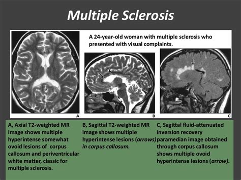 Disorders of corpus callosum