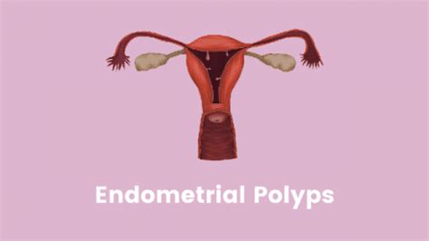 Endometrial Polyps : Symptoms, Diagnosis, Treatment | Gunjan IVF World