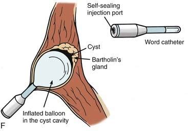 Word Catheter