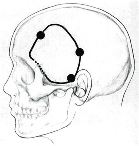 Position of burr holes for cosmetic frontotemporal craniotomy. Dotted ...