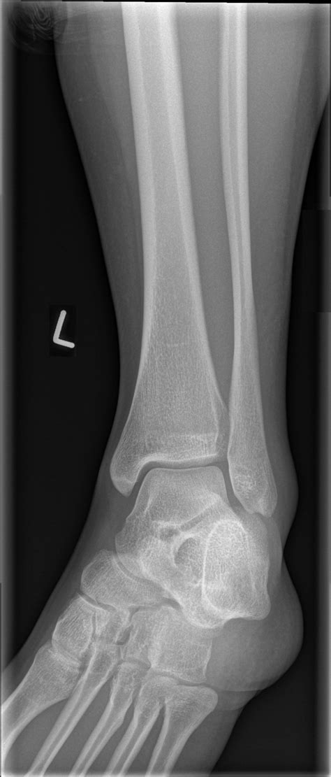 Normal ankle | Image | Radiopaedia.org