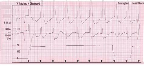 Transcutaneous Pacing (TCP) With and Without Capture - ACLS Medical Training