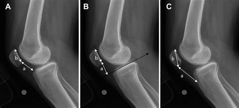 Medial Patellofemoral Ligament Reconstruction Reduces Radiographic ...