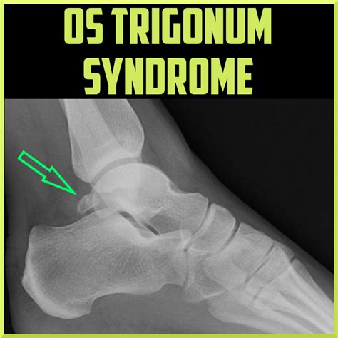 Os trigonum syndrome - Sports Medicine Review