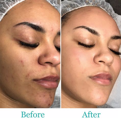 BB Glow Microneedling Treatment | Natalie's Skin Solutions