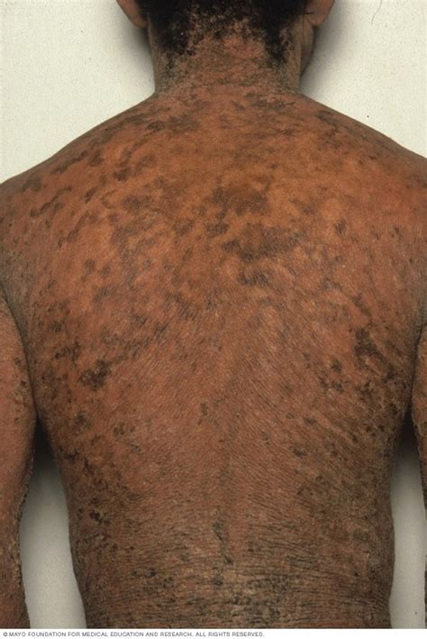 Ichthyosis vulgaris - Mayo Clinic