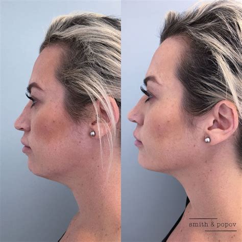 Kybella to contour Jaw line. | Botox, Kybella, Cheek fillers