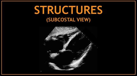 Cardiac STRUCTURES! Subcostal views, Echocardiography. - YouTube