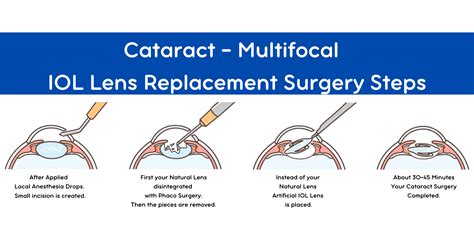 Monofocal Cataract Surgery - Lens Replacement - Akıllı Lazer Göz Merkezi