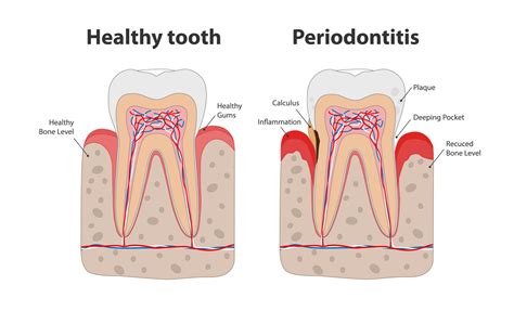 Periodontal Scaling & Root Planing - Dental Square