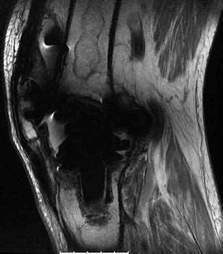 Magnetic Resonance Imaging in Total Knee Replacement | Musculoskeletal Key