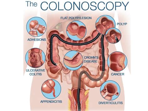 Colonoscopy - Prashant Kedia MD | Endoscopic Sleeve Gastroplasty ...