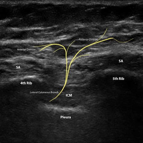 USG anatomy for the serratus anterior plane block. SA serratus ...