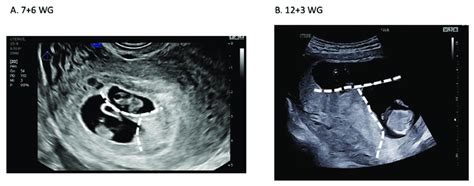 Ultrasound assessment of dichorionic diamniotic twin pregnancy. (A ...