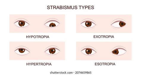 341 Deviation Of The Eye Images, Stock Photos & Vectors | Shutterstock