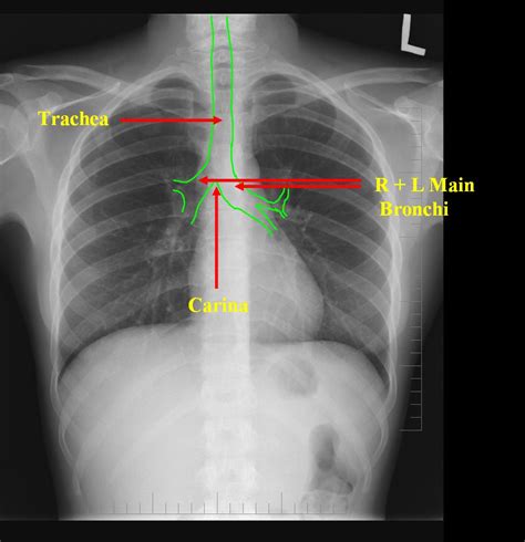 Chest X Ray Anatomy - vrogue.co