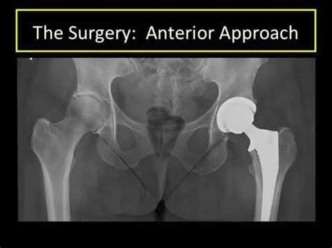 Anterior Approach Hip Replacement Basics - YouTube