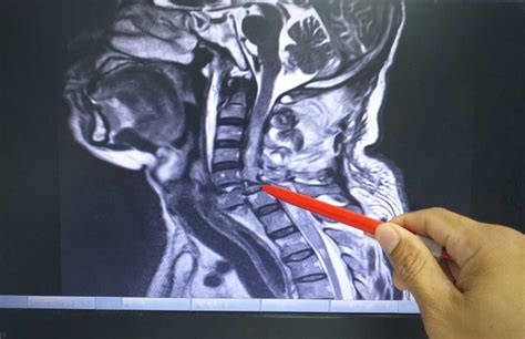 Cervical Spine Mri Procedure