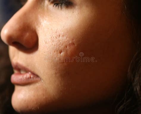 Inflamed Skin of the Face in Pimples and Acne. Keloid Scars from Acne Stock Image - Image of ...