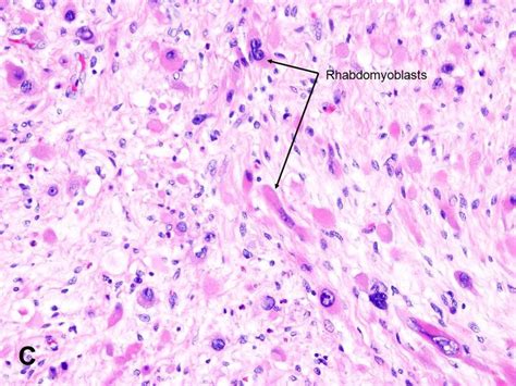 Rhabdomyosarcoma - American Urological Association