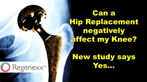 Hip Replacement Risks Include Disrupting Hip and Knee Alignment - Regenexx®