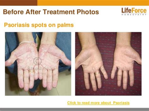 Psoriasis on Hands Photos: Before and After Treatment Pictures of Pat…