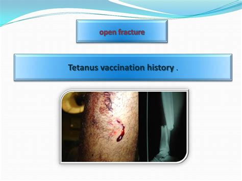 Open Fracture Antibiotics prophylaxis