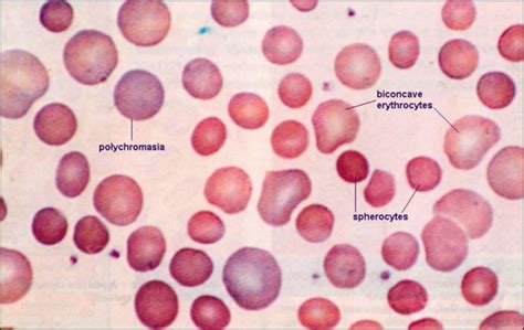 Spherocytosis and hereditary spherocytosis causes, symptoms & treatment