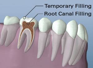 Root Canal | Root Canal Therapy | Gurnee IL | Root Canal Pain