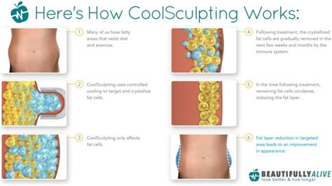 What Is CoolSculpting?- Everything You Need To Know