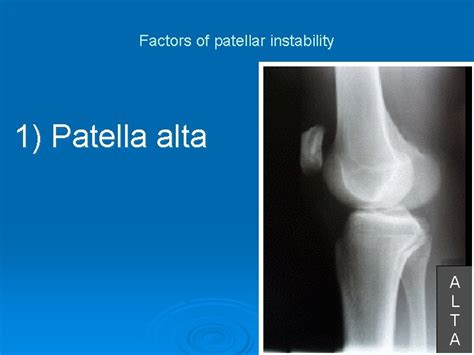 Surgical Treatment Of Habitual Dislocation Of The Patella