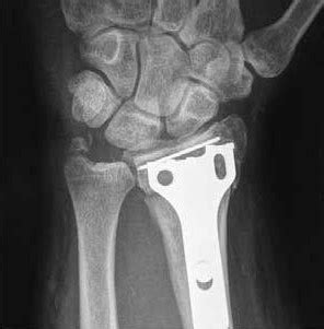 cpt code for orif distal radius and ulna fracture