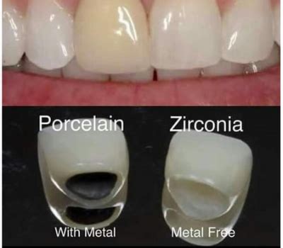 Canadá Para editar Prestigio zirconia crown vs ceramic crown gráfico ...