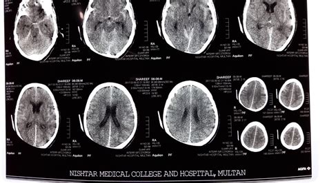 CT Scan of Subarachnoid Hemorrhage || CT Scan SAH || Intracranial bleed ...