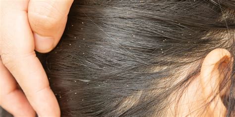 7 Common Signs of Lice - Head Lice Symptoms & Treatment