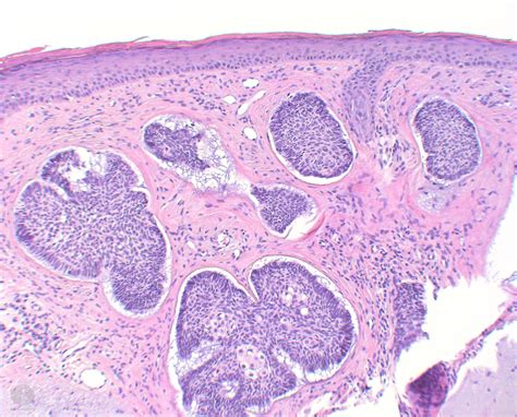 Morpheaform Basal Cell Carcinoma Histology