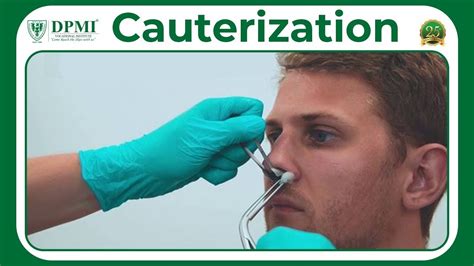 Cauterization: What Is Cauterization Used For? Cauterization Procedure & Risks - YouTube