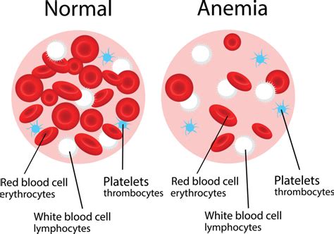 Anemia: Causes, Symptoms, Diagnosis, Treatments