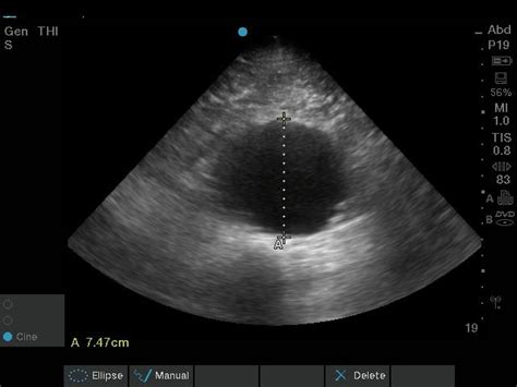 Abdominal Aorta Ultrasound