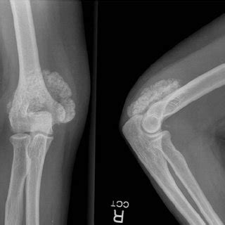 (PDF) Heterotopic calcification