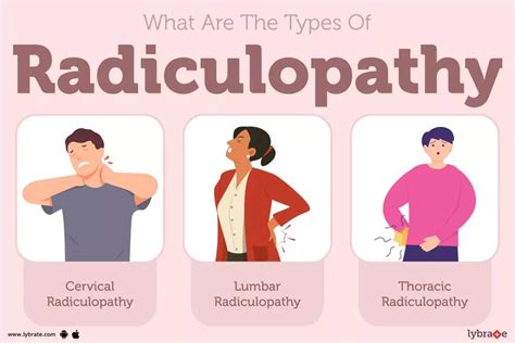 Radiculopathy: Causes, Symptoms, Treatment and Cost