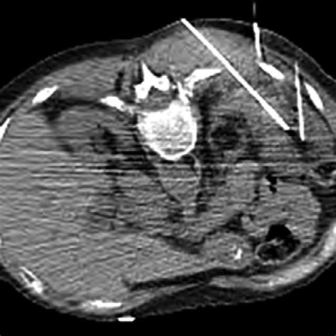 Classic tophi. This patient has classic appearance of tophi, including ...