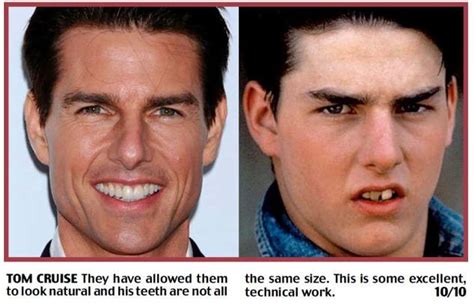 Celebrities with Fake Teeth | List of Famous People with Dentures and Dental Implants