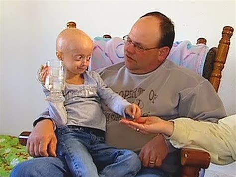 Progeria clinical trial at Boston Children's Hospital - YouTube