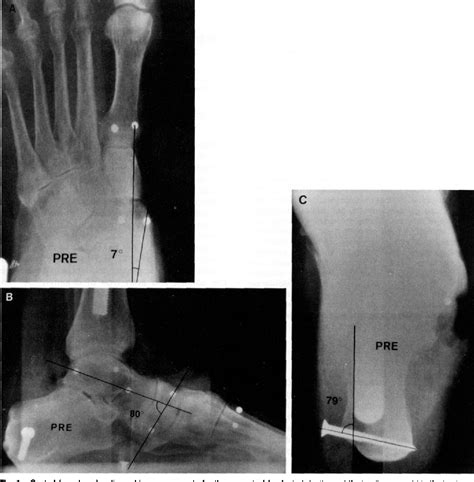 Transverse tarsal joint | Semantic Scholar