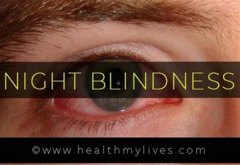 NIGHT BLINDNESS-CAUSES,SYMPTOMS,TREATMENT&PREVENTION