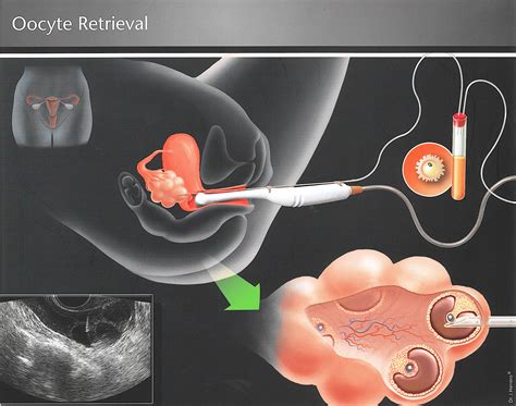 Oocyte-Retrieval | Fertility Solutions