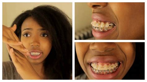 Adult Braces Journey Part 6 Update: Powerchains, Pain, Overbite ...