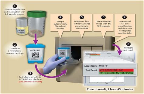 Detection Of Mycobacterium Tuberculosis In AFB, 48% OFF