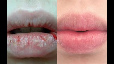 How To Remove Dead Skin From Lips Naturally | Lipstutorial.org